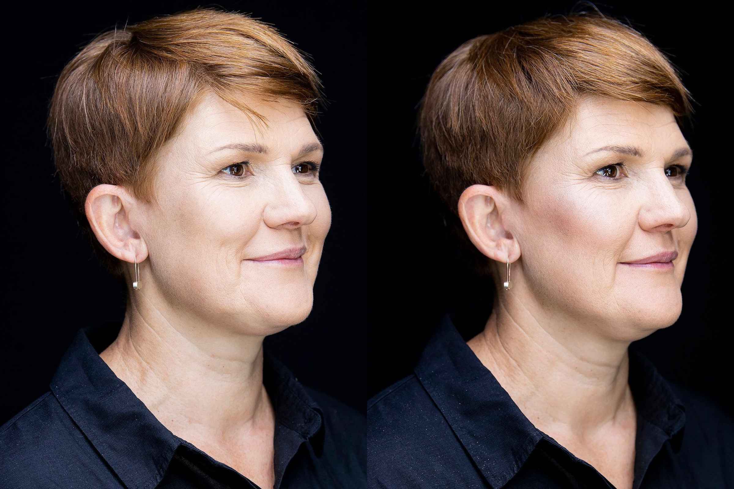 MyEasyGlow model before and after rosy glow